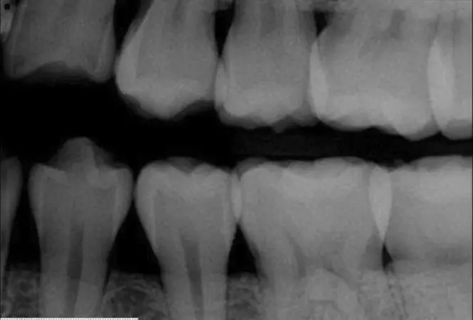 Digital X Rays